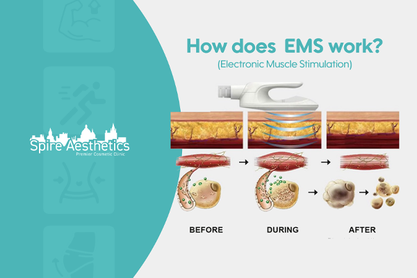 EMS treatment for post pregnancy weight loss treatment Bolton