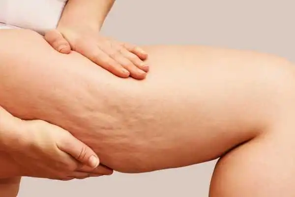 Image of woman showing leg with cellulite Bolton