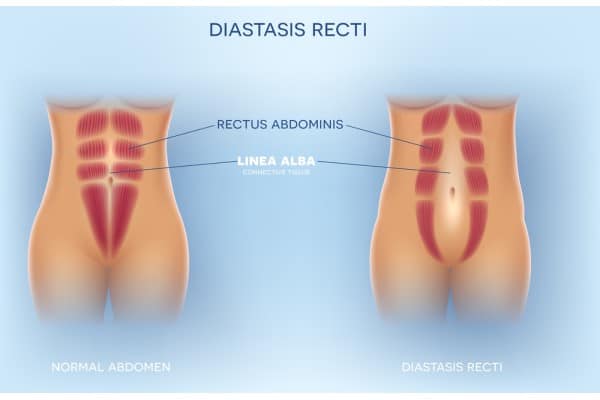 What Non-Surgical Options Are Available for Diastasis Recti Bolton?