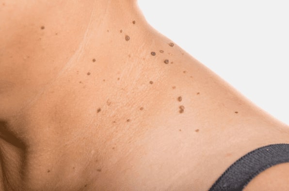 Are you looking for easy skin tag removal Bolton - then contact Spire today!