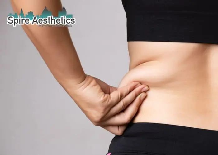 Image of woman pinching fat on their hips Bolton. Fat Freezing treatment