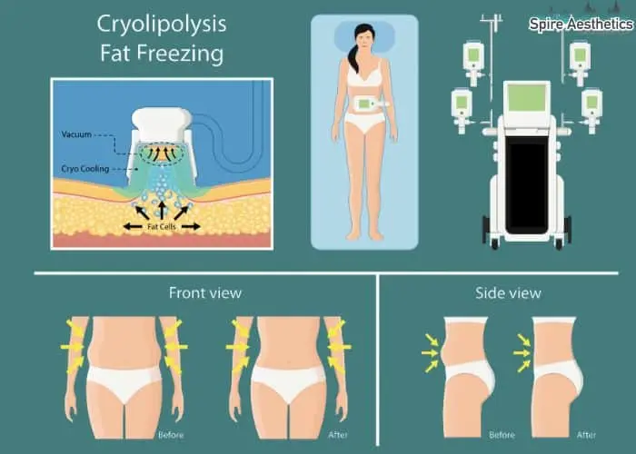 Fat freezing treatment Bolton benefits for competitions to remove stubborn fat deposits.