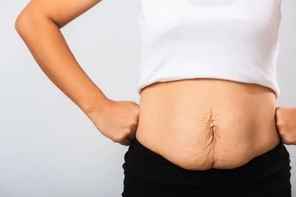 Image of a woman's stomach after weight loss with sagging skin following a gastric band Bolton