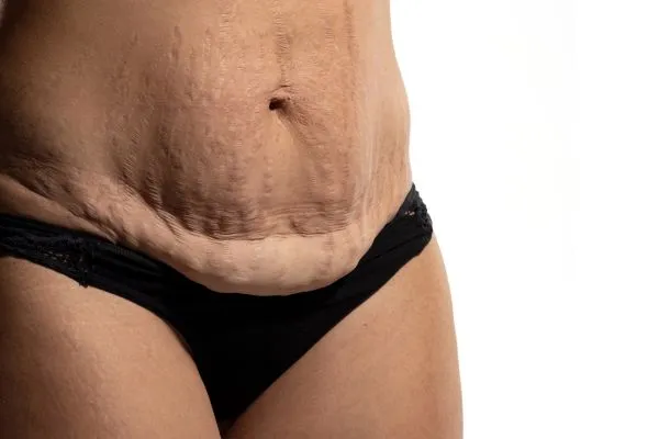 Image of womans stomach after weight loss injections Bolton showing saggy skin
